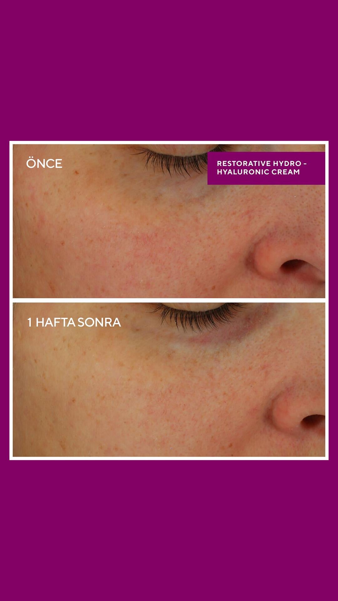 Restorative Hydro-Hyaluronic Cream - Yoğun Onarıcı Ultra Güçlü Nemlendirici 50ML
