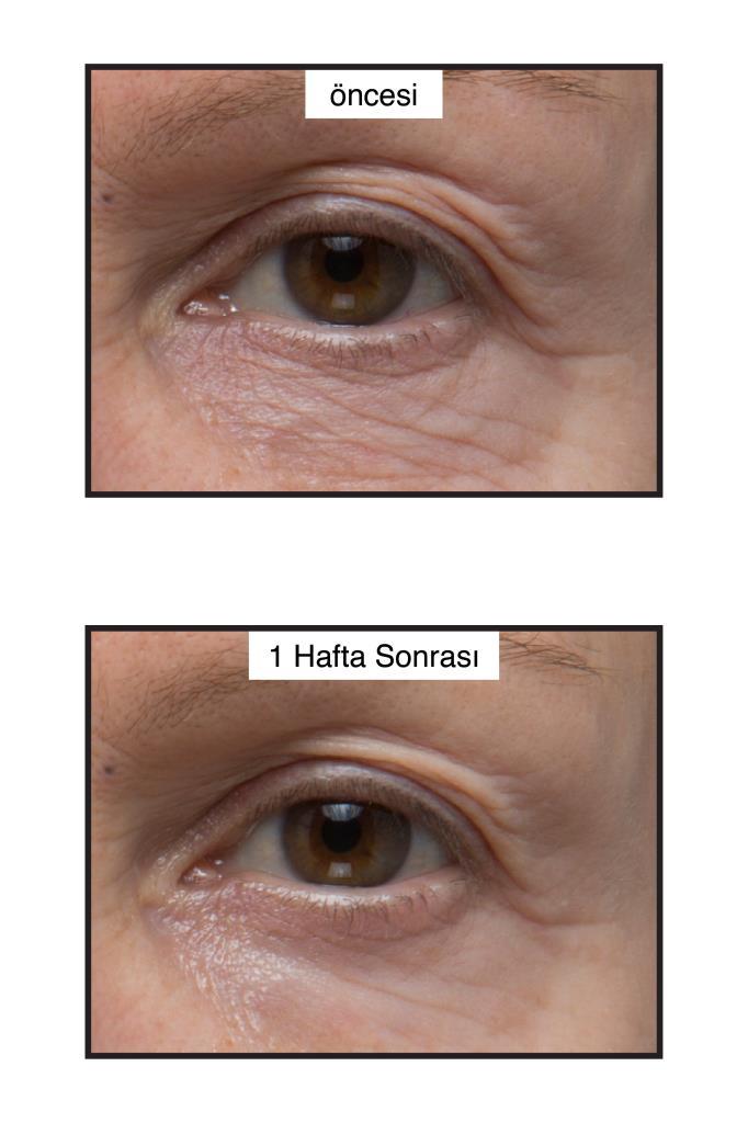 Renewing Eye Cream – Kırışıklık ve Koyu Renkli Halkalarda Etkili Göz Kremi 15 ML